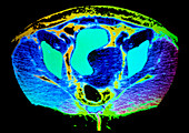 Coloured CT scan showing uterus wihth a fibroid