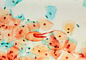 LM of threadworm (pinworm) in a cervical smear