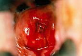Colposcopy CIN3: precancerous cervix,iodine stain