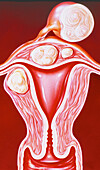 Illustration of fibroids in the uterus