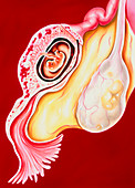 Illustration showing an ectopic pregnancy