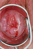 View of a cervix with moderate (CIN 2) dysplasia