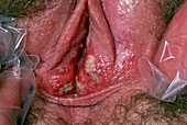 Vulval ulcers - unknown cause