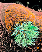 Coloured SEM of cells of Brenner tumour in ovary