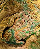Coloured SEM of adenocarcinoma of the human uterus