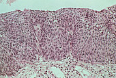 LM of grade III cervical intraepithelial neoplasia