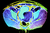 Coloured CT scan of large fibroid tumour in uterus