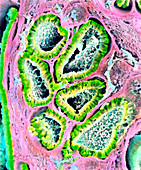 Coloured SEM of Sertoli-Leydig tumour in ovary