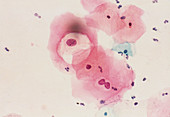 LM of cervical smear revealing HPV infection