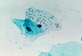 LM of cervical smear showing bacterial infection