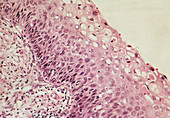 LM of cervical cells showing mild dysplasia (CIN1)