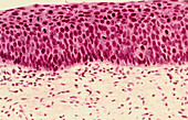 LM of cervical cells showing severe dysplasia