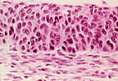 LM of cervical cells showing severe dysplasia