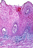 LM of section of through a genital wart