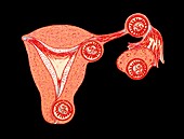 Artwork showing multiple ectopic pregnancies