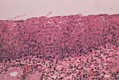 LM of cervical cells showing mild dysplasia (CIN1)