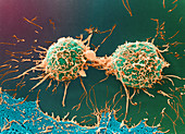 Coloured SEM of cervical cancer cells dividing