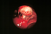 Ovario-uterine adhesions