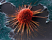 Cervical cancer cell,SEM