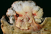 Vulva tumour