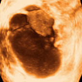 Endometriosis,ultrasound scan