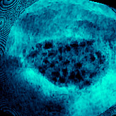 Polycystic ovary,ultrasound scan