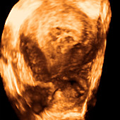 Cancer of the chorion,ultrasound scan