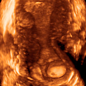 Cervical cyst,ultrasound scan