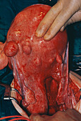 Ovarian cyst,surgery
