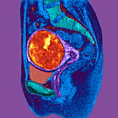 Uterine fibroid,MRI scan