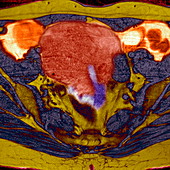 Uterine fibroid,MRI scan