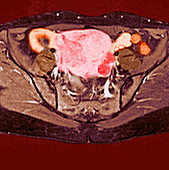 Uterine fibroid,MRI scan