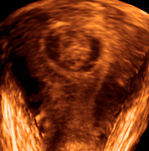 Uterine fibroid,ultrasound scan