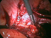 Ovarian adhesion surgery