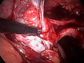 Fallopian tube surgery