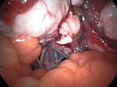 Ovarian adhesions