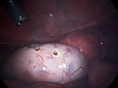 Polycystic ovary syndrome treatment