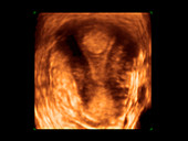Endometrial polyp,ultrasound scan