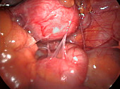 Omental adhesions to the uterus