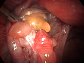 Fallopian tube cyst