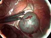 Removal of an ovarian cyst (3 of 4)