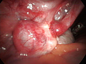 Ovarian adhesions to a Fallopian tube