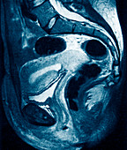 Uterine cancer,MRI scan