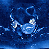 Polycystic ovaries,MRI scan