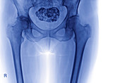 Calcified uterine fibroid,X-ray