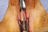 Vaginal prolapse repair surgery