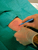 Norplant contraceptive implant surgery