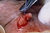 Tying vas deferens during a vasectomy operation
