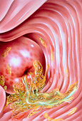 Illustration of Trichomonas of the cervix
