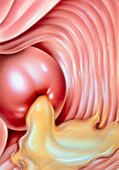 Illustration of gonorrhoea of the cervix